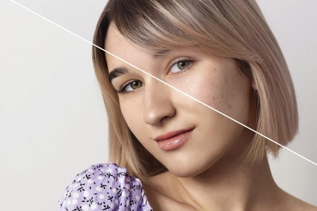 رفع جوشهای پوستی