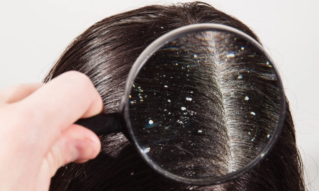 رفع شوره مو